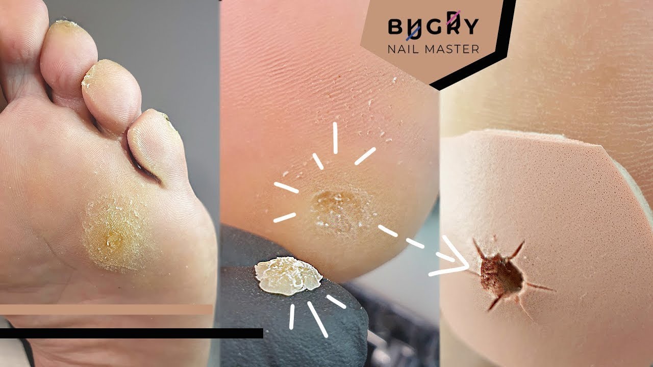 diferencia entre callo y dureza